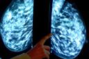 A new device being developed by scientists could help monitor the growth of breast cancer tumours