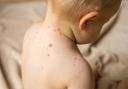 CONCERN: A child with measles as the UK Health Security Agency has reported a rise in cases across the UK