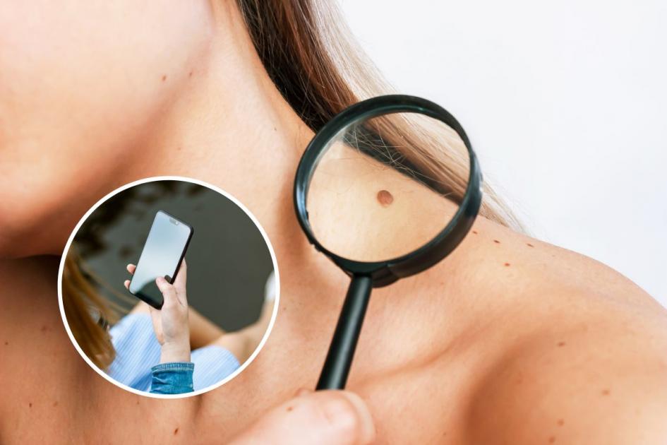 Skin cancer: How this smartphone camera lens could save your life