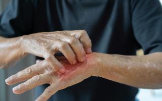 Scabies is a highly contagious skin condition which causes bumpy, itchy rashes to form